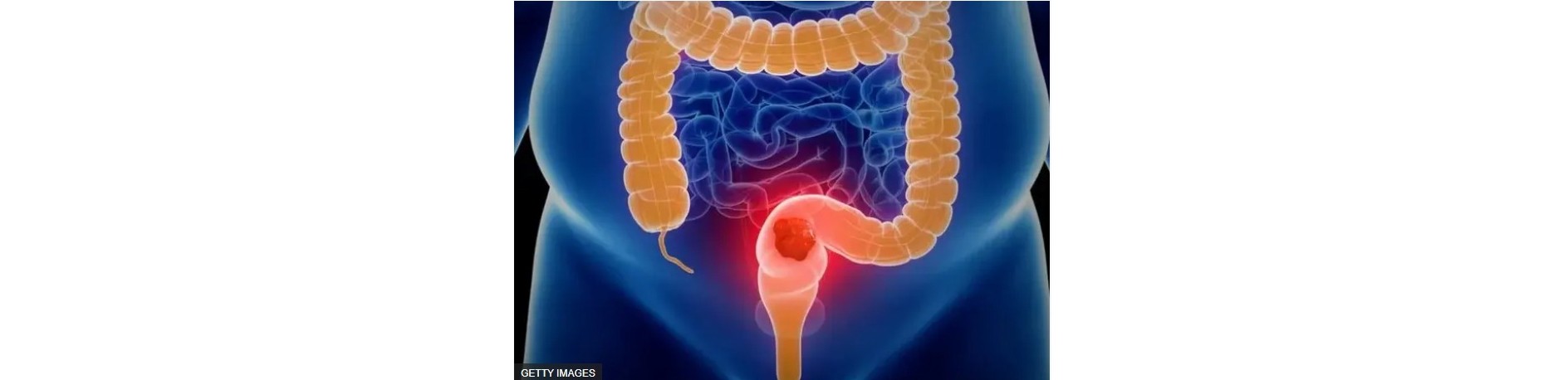 Image de cancer du côlon bbc.com 1bis.jpg